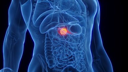 « C’est une révolution » : pourquoi le daraxonrasib, un nouveau traitement contre le cancer du pancréas, suscite de grands espoirs