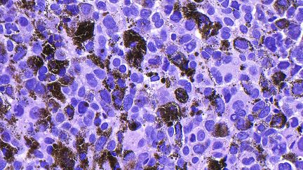 Cancer : le premier vaccin thérapeutique à ARN messager donne de très bon résultats contre le mélanome, le cancer de la peau le plus mortel