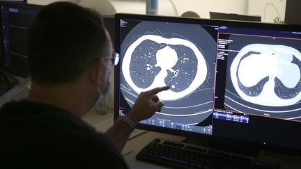 Deux nouveaux traitements contre le cancer du poumon améliorent les chances de survie des patients